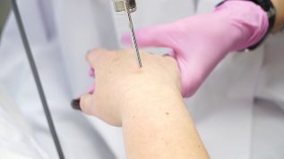 Peremajaan laser pada kulit tangan